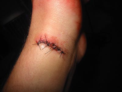 cuts on wrist. heavily-bandaged wrist and